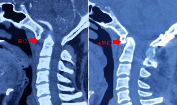 落枕是因为着凉吗,睡姿不正确导致的落枕怎么办