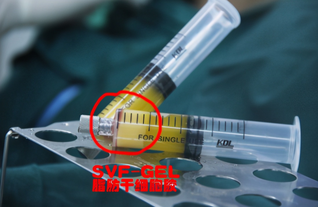 太阳穴凹陷自体脂肪填充怎么样,太阳穴凹陷显凶吗