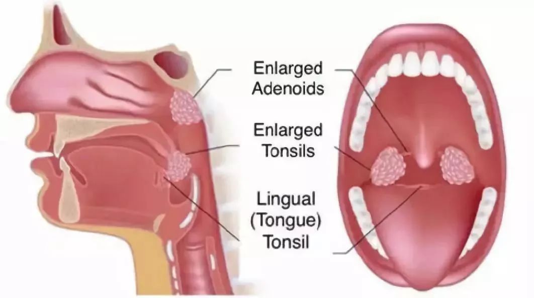 慢性咽炎喉咙痛干燥怎么办,上火导致咽炎吃什么药有效
