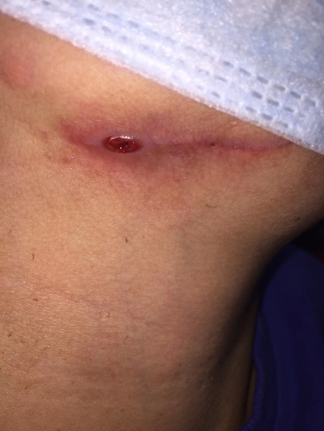 牙源性上颌窦炎牙龈瘘管,牙源性脓肿的症状