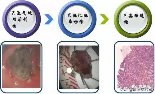 内镜下粘膜剥离术属于esd还是emr,胃肠息肉内镜下黏膜剥离术