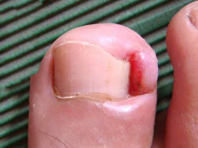 甲沟炎怎么办教你一招解决,甲沟炎怎么办用什么抗生素