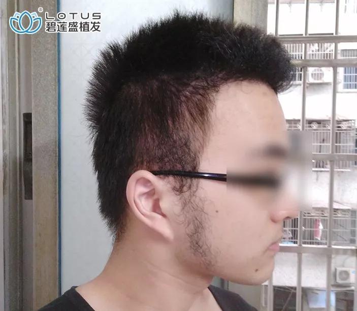 发际线后移额角大头发稀疏怎么办,额角发际线还能恢复吗