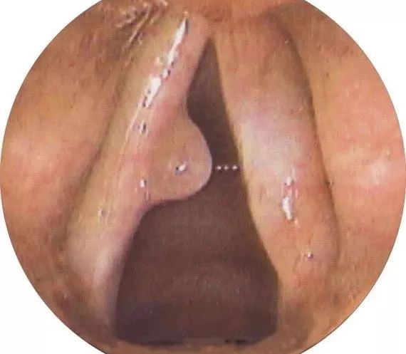 肠息肉切除好还是不切除好,肠息肉切除还是不切除好