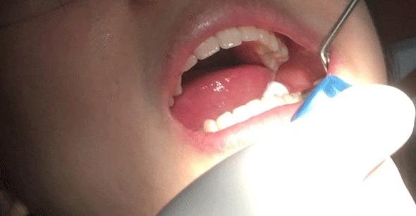 宝宝牙齿还能用护牙素吗,宝宝牙齿防护