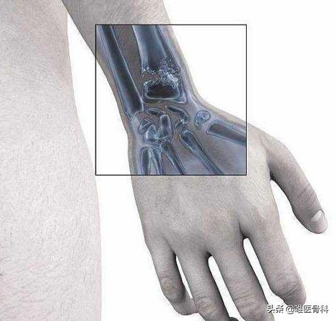 不小心摔伤骨折了怎么办,户外骨折怎么办