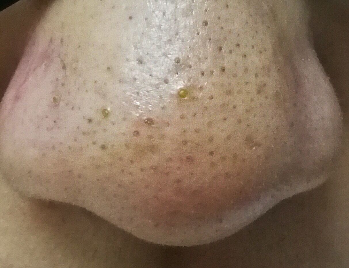 黑头如果不管的话会怎样,如果不清理黑头会怎样