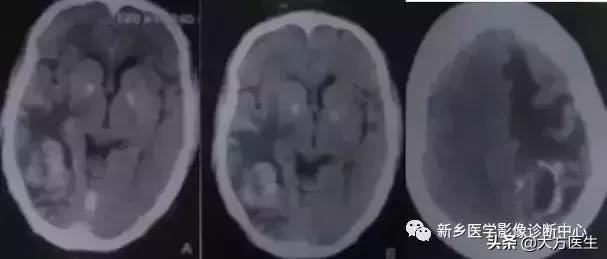 钙化灶是良性肿瘤的可能性大吗,颅内肿瘤钙化发生率最高