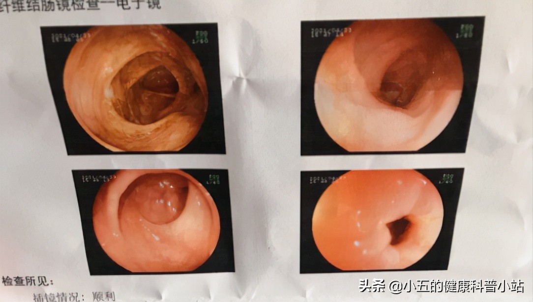 结肠息肉最好的手术方法有几种,做一个结肠息肉手术大约要多少钱