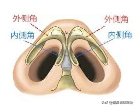 鼻头变大如何修复,鼻修复半年了鼻头变大怎么办