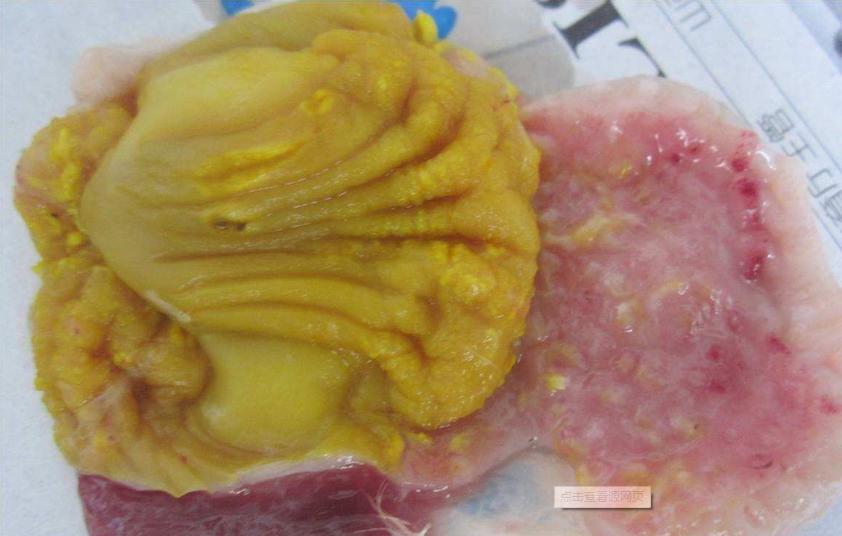 腺胃炎的发病原理,胃炎引起头疼吃什么药