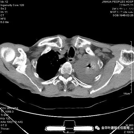 手术引起乳糜胸,有没有做了肺结节手术后是误诊的