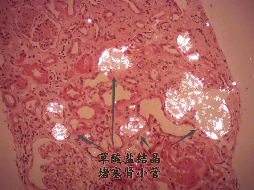 长期吃诱发肾衰竭的食物,阿伯吃东西