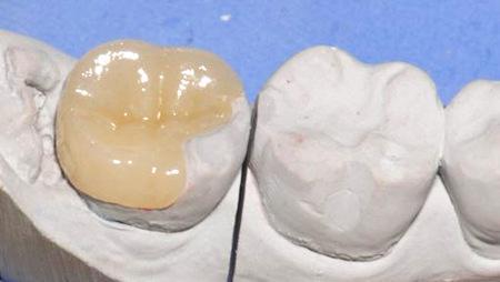 牙齿上有黑点但是不疼是怎么回事,牙齿上有小黑点但是不痛是蛀牙吗