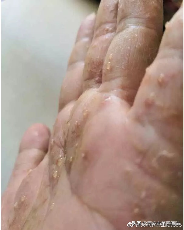 为什么一到夏天手上会长小水泡,夏天手脚长小水泡用什么药