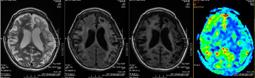 医生给脑血管搭桥,外科医生给年轻女孩做手术