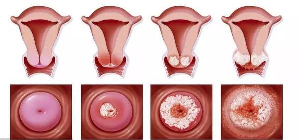 宫颈癌前病变三级治疗费用多少,北京治疗宫颈癌前病变的老中医