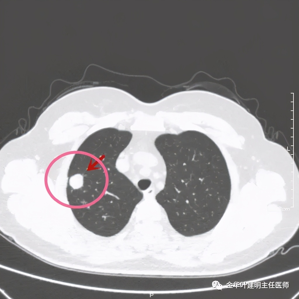 右上肺结节灶一般是什么癌,右上肺恶性肿瘤是肺癌吗