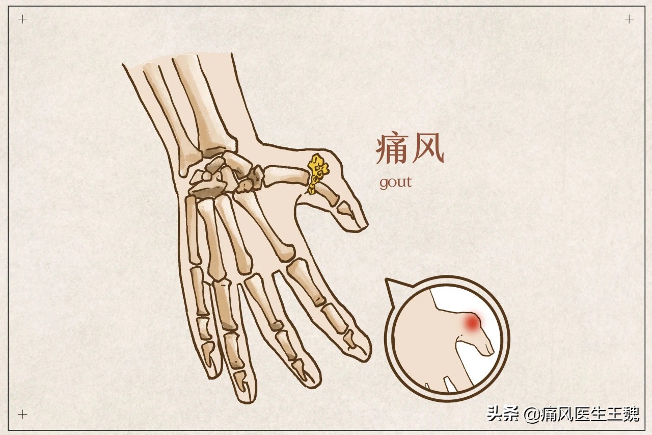 如何缓解痛风急性期疼痛,怎样快速缓解痛风肿痛