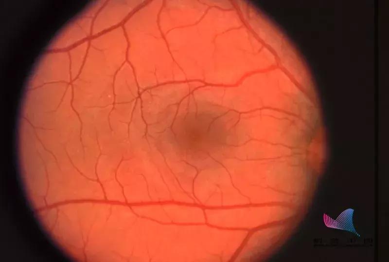 长期玩手机会导致眼睛黄斑病变吗,玩手机黄斑病变失明能治好吗