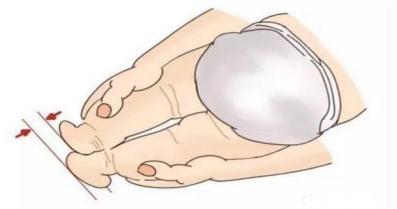 宝宝皮纹不对称是什么意思,皮纹不对称有必要做髋关节彩超吗