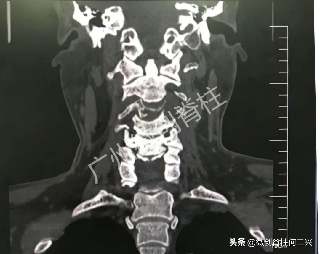 颈椎髓内肿瘤手术的权威专家,微创治疗肿瘤