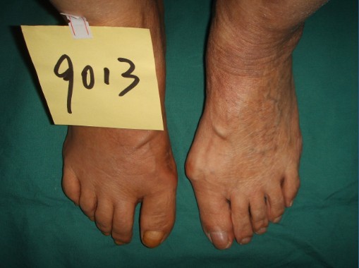 真实的重度大脚骨矫正案例,哈尔滨做大脚骨手术