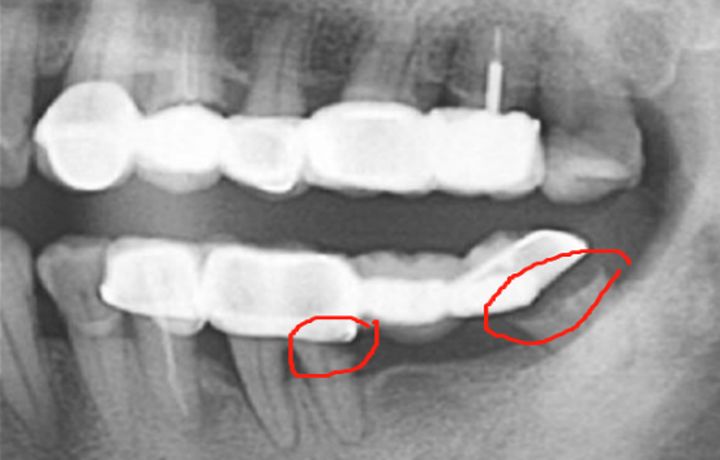 十八岁是矫正牙齿好还是烤瓷牙好,牙齿中线不齐能通过烤瓷牙修复吗