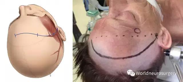 翼点入路技巧图解,翼点入路的开颅要点