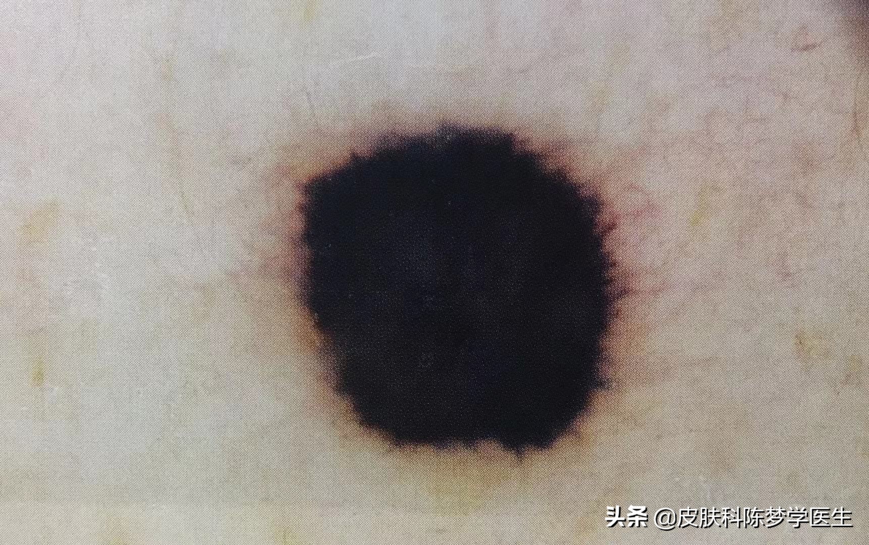 激光点痣为啥痣大了,颠覆你认知的祛斑方式