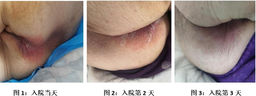 皮肤损伤不良事件分析及整改措施,局部潮湿怎么治疗最有效