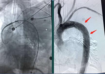 主动脉血管破裂能救吗,血压高主动脉夹层破裂