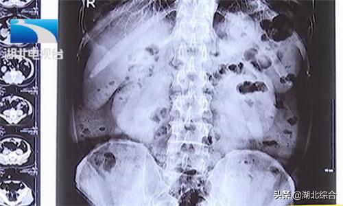 男子患肾结石八年未及时治疗,右肾多发结石并右肾严重积水