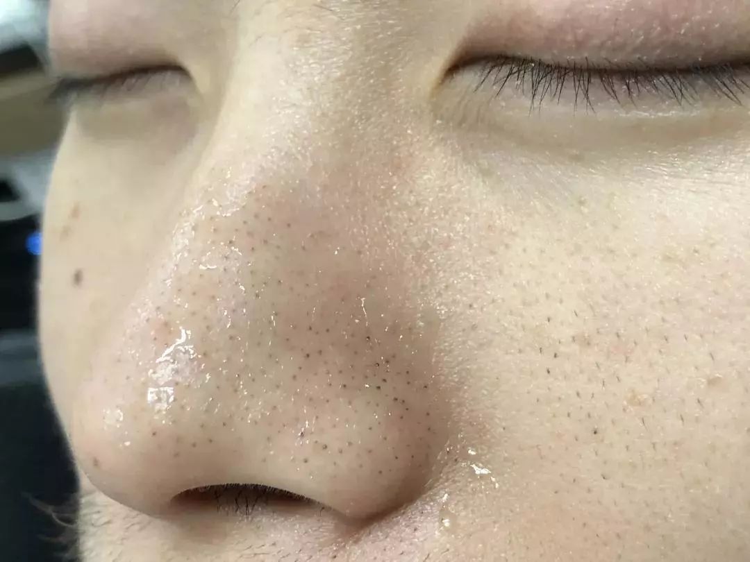 荷荷巴油去黑头正确使用方法,荷荷巴油去黑头真的有效么