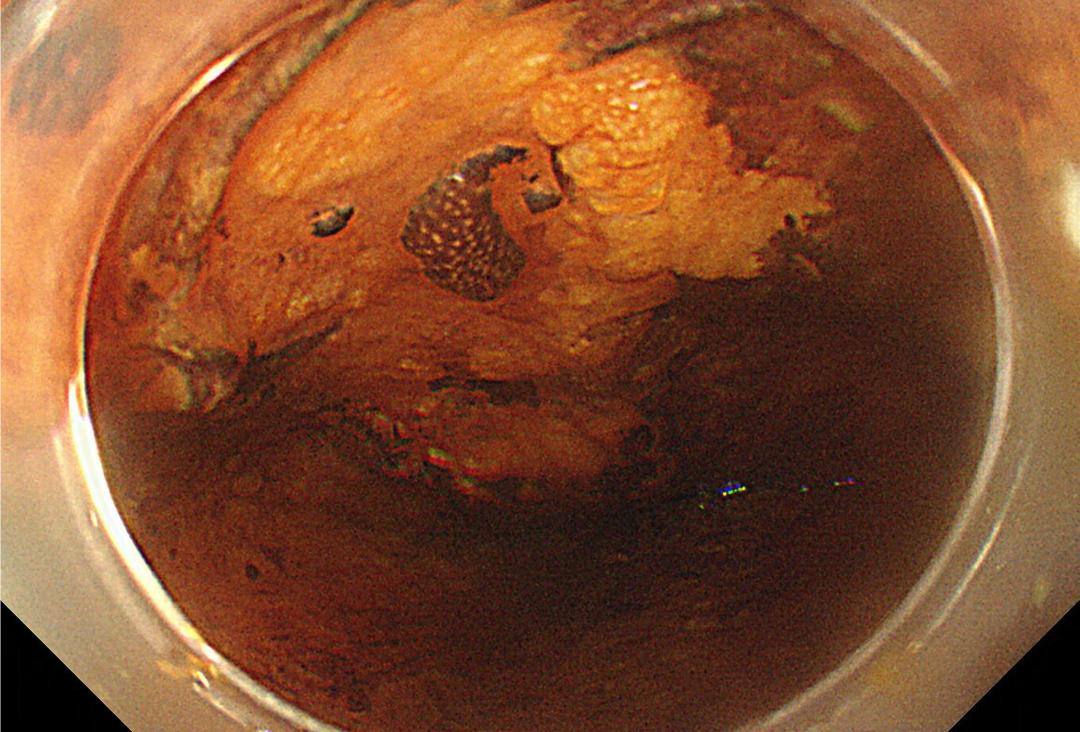 肿瘤防治知识资料,肿瘤科普与指南