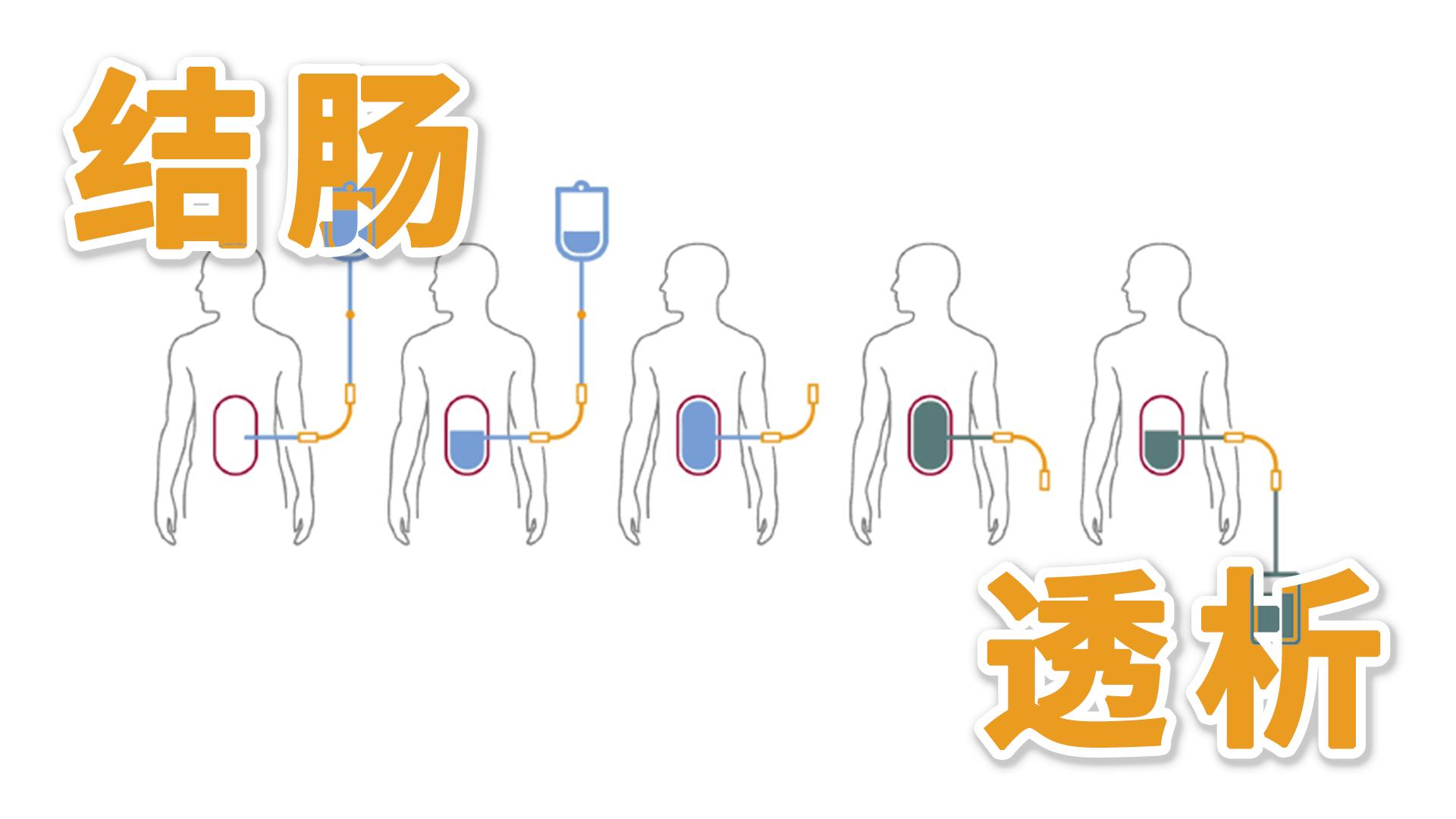 尿毒症的肾脏替代治疗方式,尿毒症替代治疗