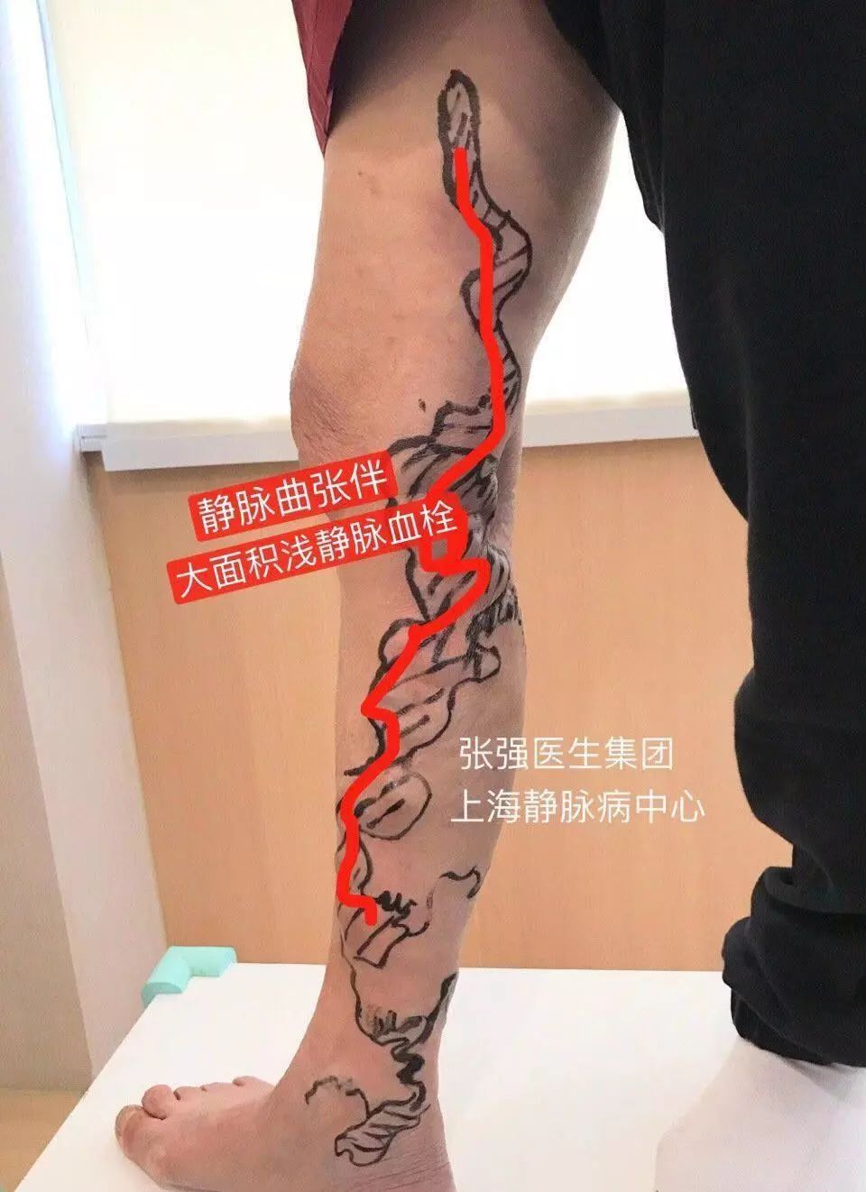 下肢静脉曲张血栓性静脉炎的症状,静脉曲张怎么会引起血栓性静脉炎