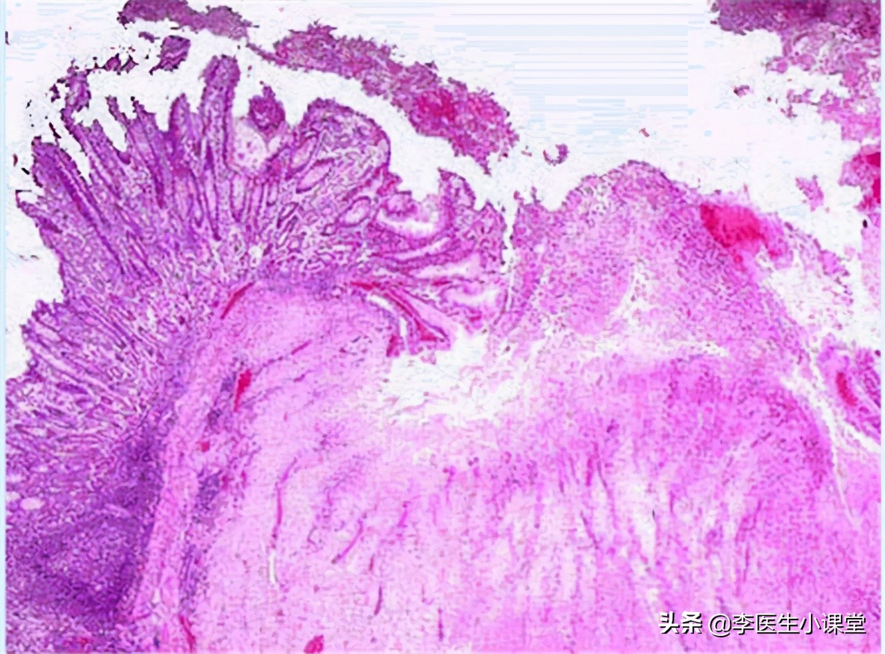 慢性浅表性胃炎伴糜烂反复发作,浅表性胃炎有三十年老反复发作