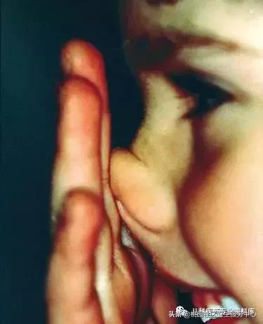 过敏性鼻炎手术的全过程,治疗过敏性鼻炎有效的药