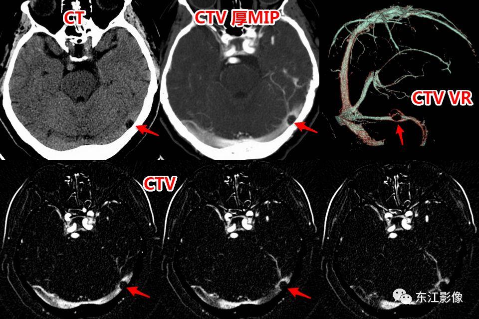 头颅mri扫描影像哪里找,头颅影像mra详细解说