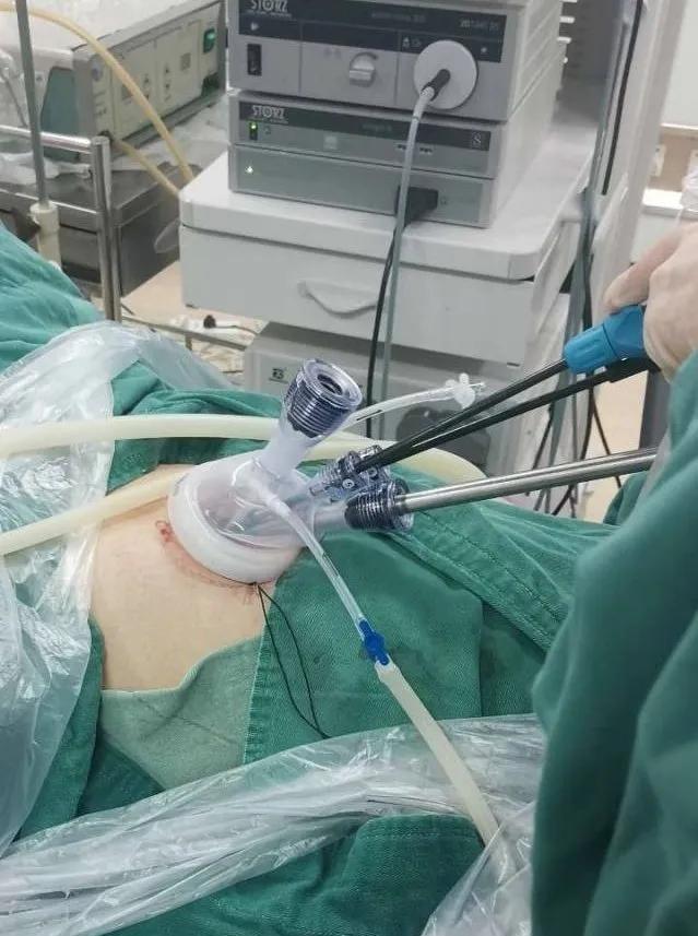 从“微创”到“无痕”~长汀妇幼妇科团队成功完成两例单孔腹腔镜手术!小切口大世界