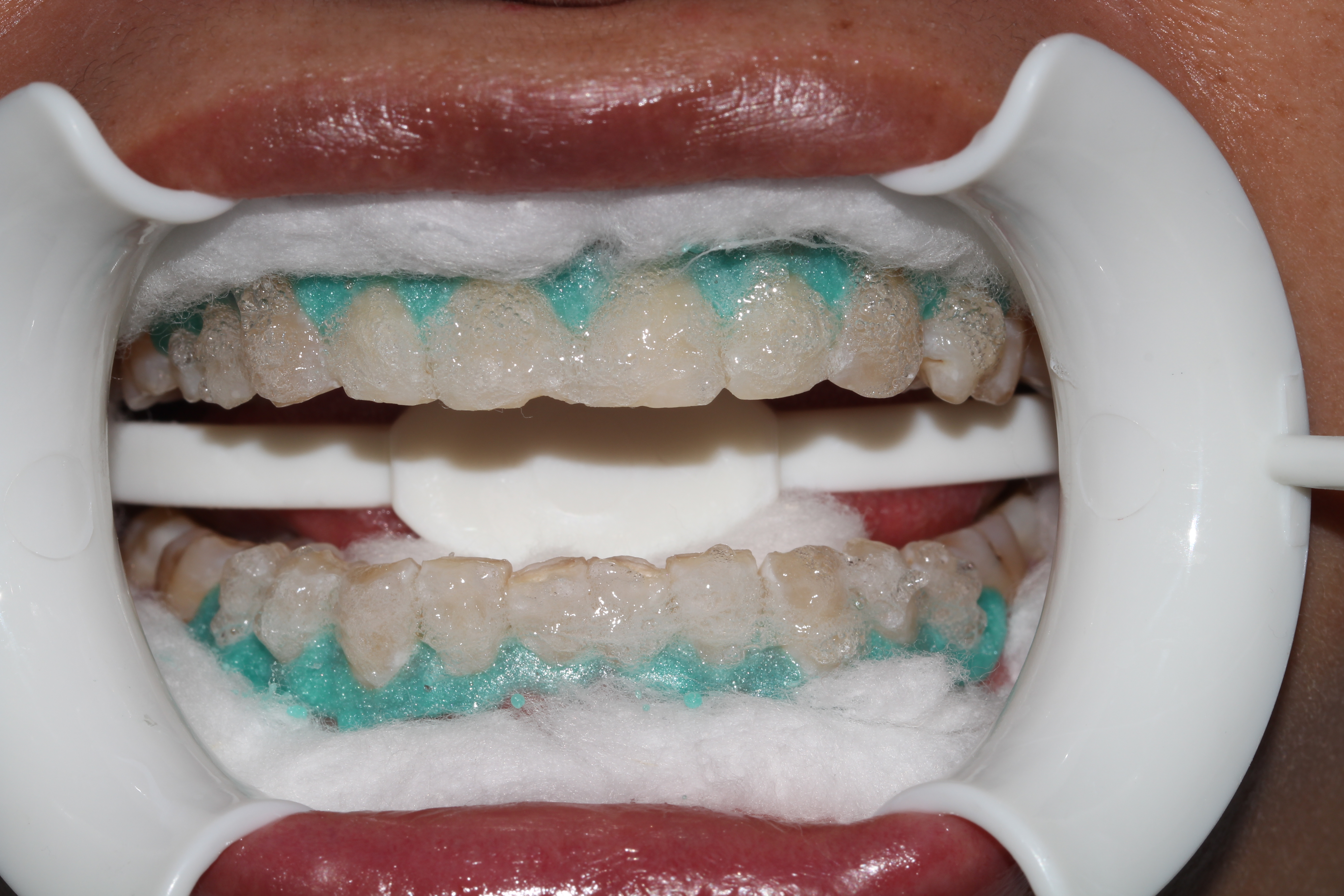 如何选择冷光美白诊所,诊室美白剂使用方法