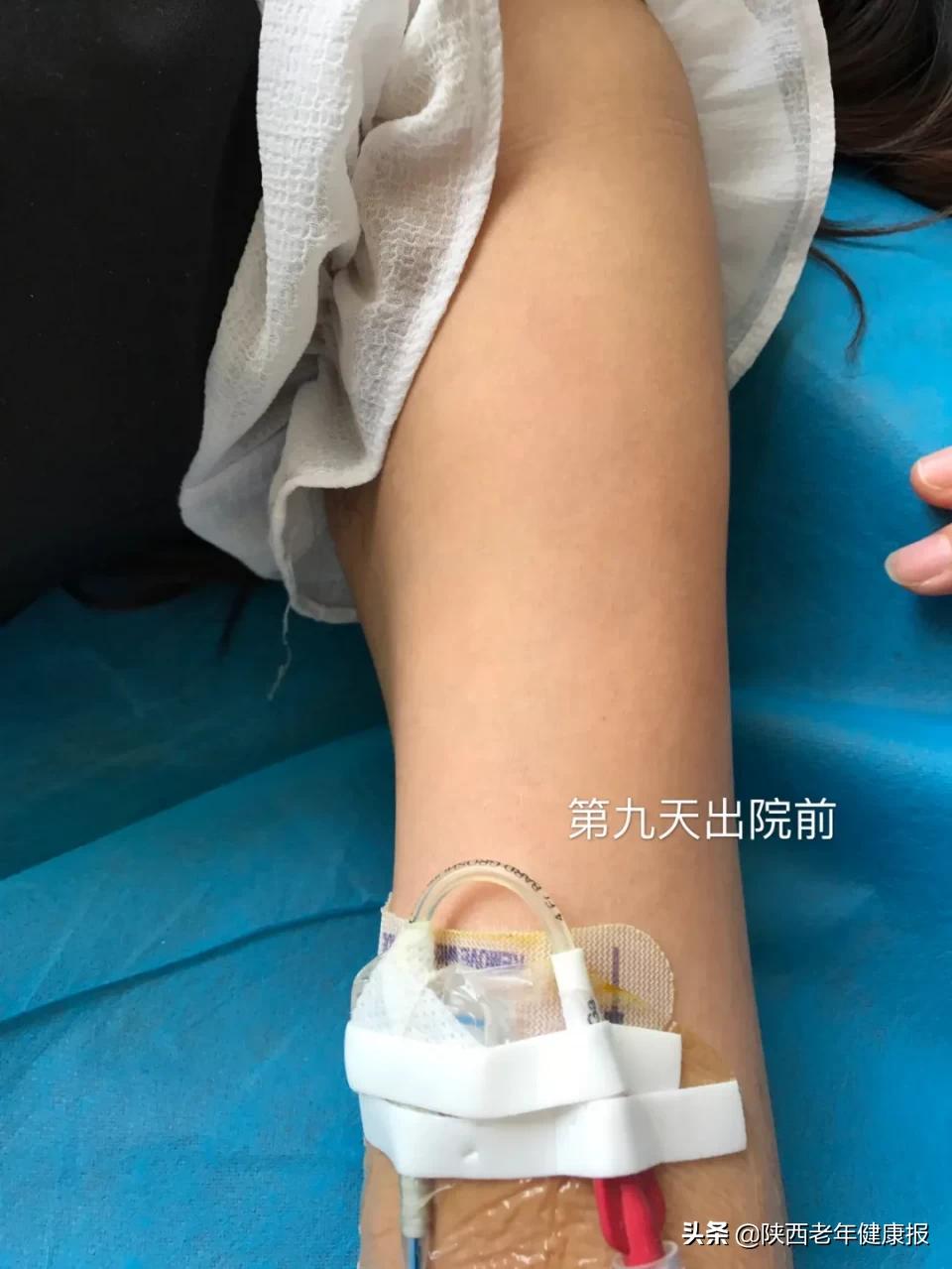 picc置管术操作过程演示,医德精湛的医术为患者解忧