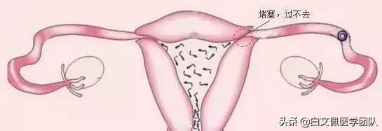 治疗输卵管性不孕重点在“通”
