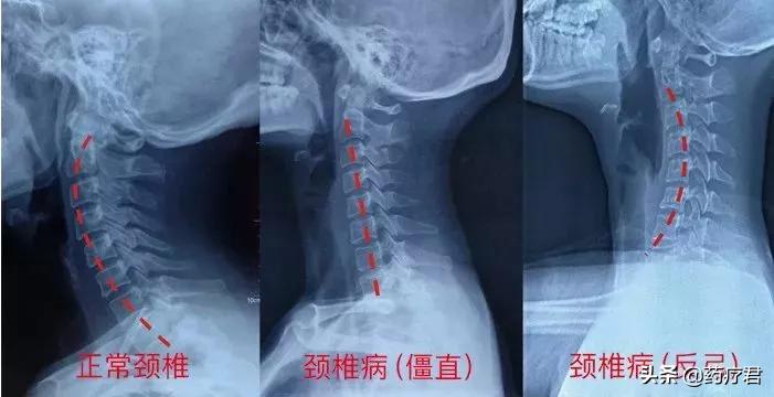 小伙10年不睡枕头，颈椎严重变形，医生教你如何挑对枕头