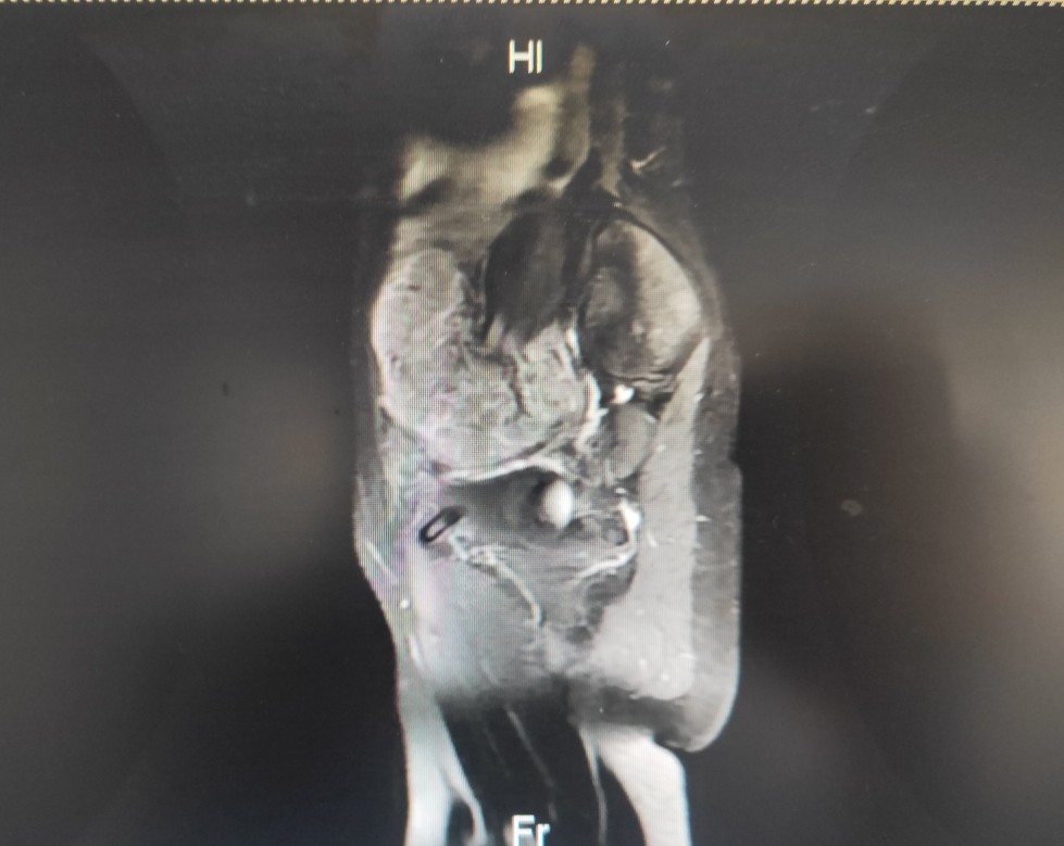 女子子宫内膜癌,22岁子宫内膜癌