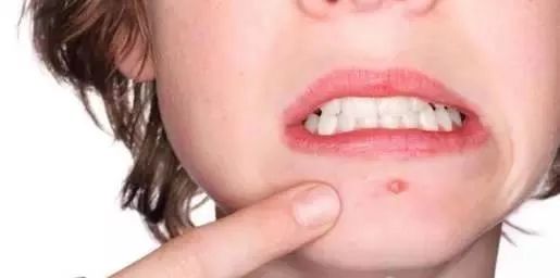 祛除闭合性粉刺软膏有哪些,下巴有闭合性粉刺怎么祛除