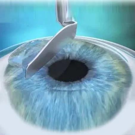 术前必须做的检查项目,近视手术的几种方式优缺点对比图