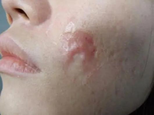 重庆北碚九院疤痕增生修复方法,上海九院孙沣