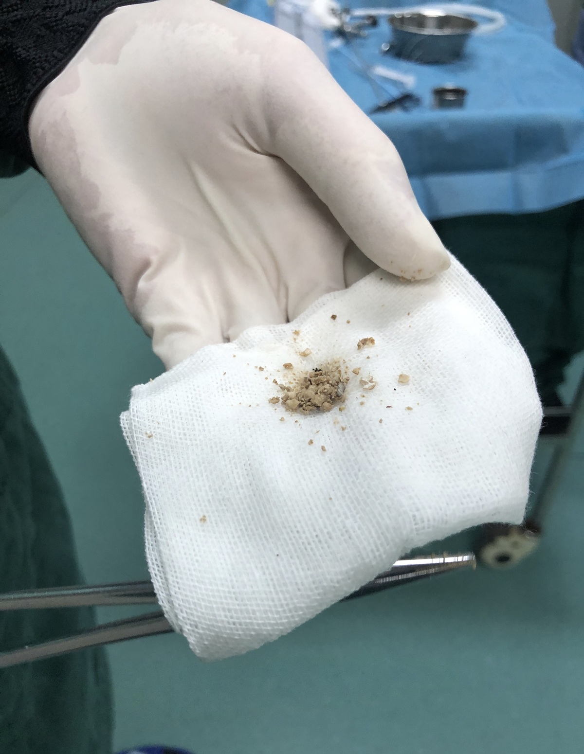 肾结石肾结晶是怎么引起的,肾结晶与肾结石分别是什么